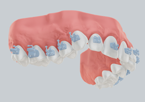 Indirect bonding u ortodonciji – od...