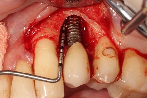 Terapija periimplantatnih bolesti